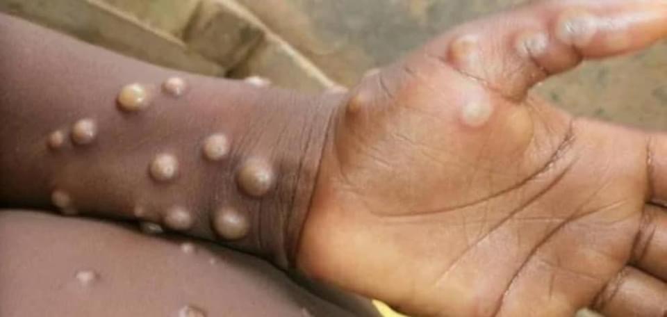 Angola sob risco elevado do vírus Mpox